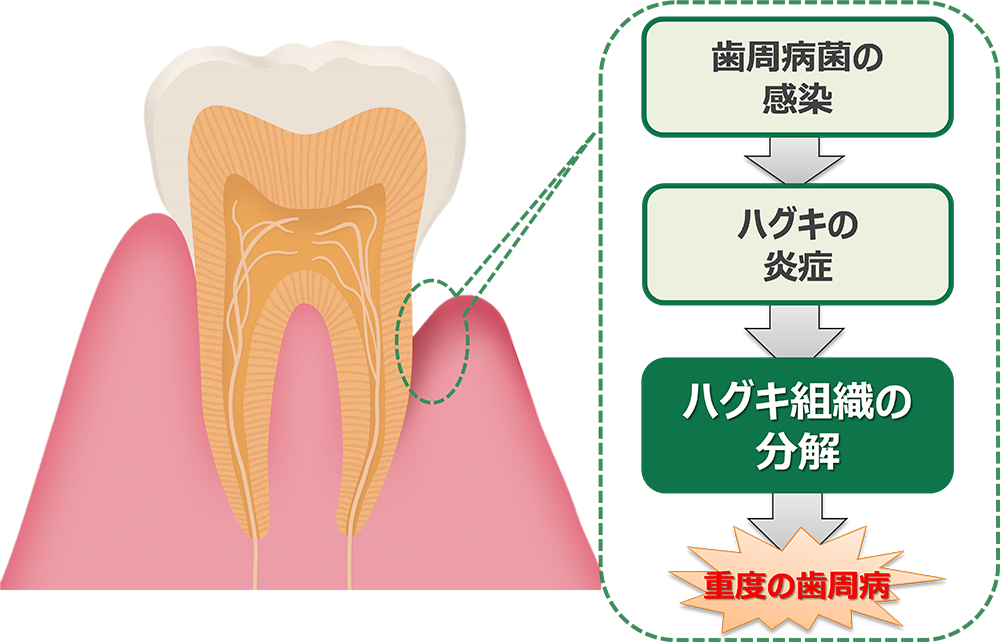 研究員に直撃！歯周病になると”ハグキ組織”が分解されているって本当？